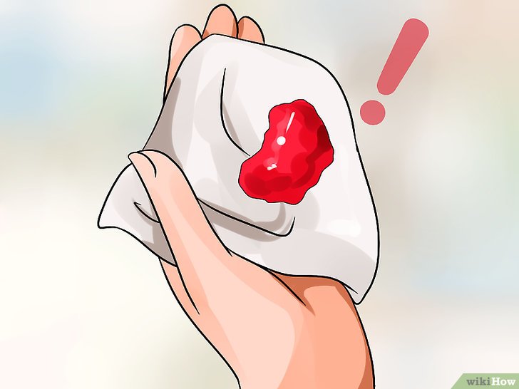Chảy máu sẩy thai