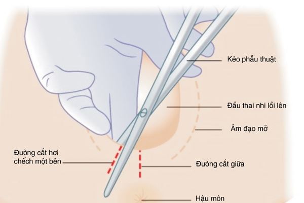 Đường cắt tầng sinh môn khi sinh con