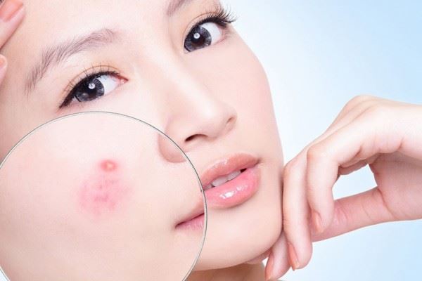 Nổi mụn khi mang thai